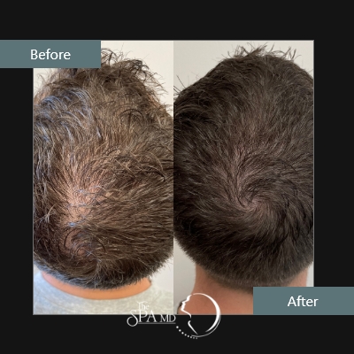 Natural Growth Factors Hair Restoration Before and After Photos | The Spa MD In Rochester Hills, MI